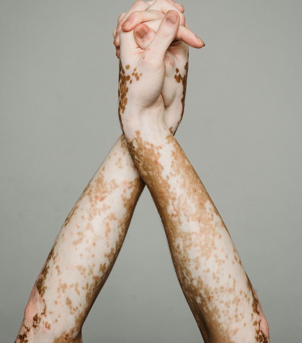 A close up of a person 's skin with stretch marks.