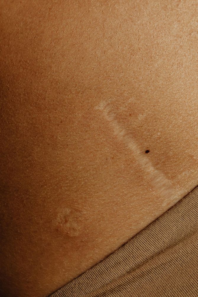 A close up of a woman 's stomach with a scar on it.