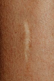 A close up of a scar on a person 's leg.