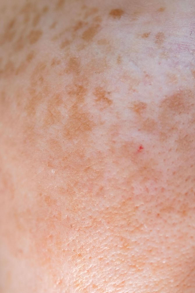 A close up of a person 's skin with freckles and a red spot.