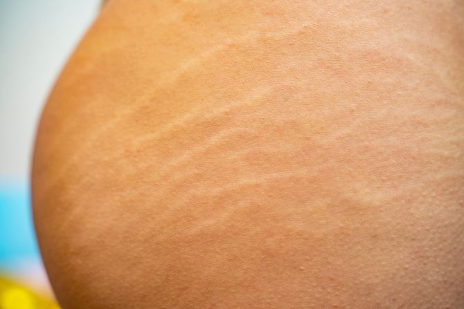 A close up of a person 's skin with stretch marks.