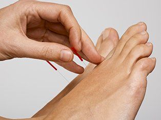 Book for an appointment for Dry Needling dry needling treatment