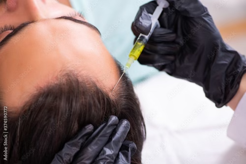 Scalp injection with yellow serum for hair restoration therapy performed by gloved medical professional