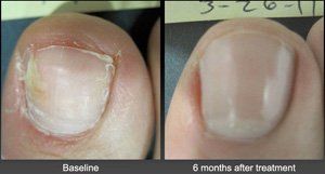 Tendonitis — Before and After of Ingrown Toenails in Marlborough, CT