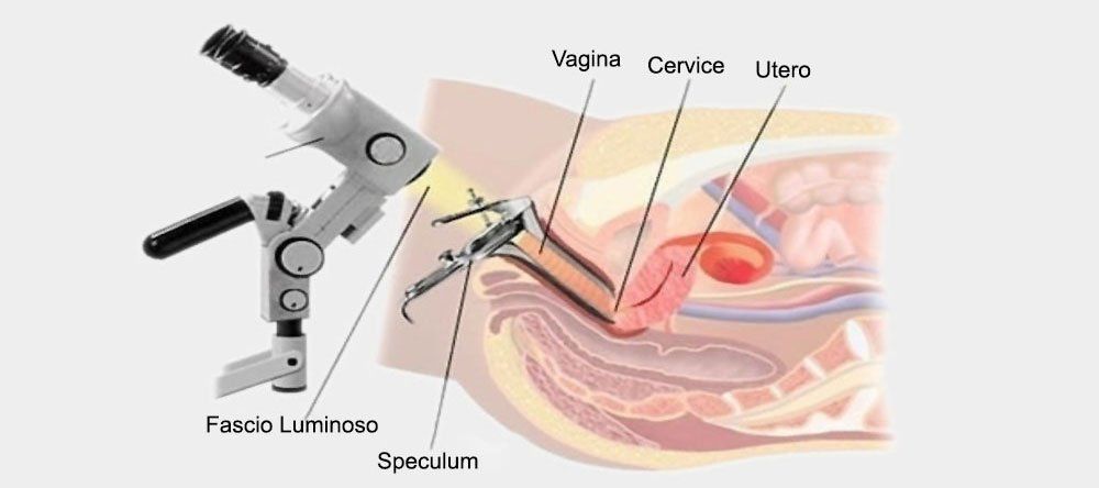 colposcopia