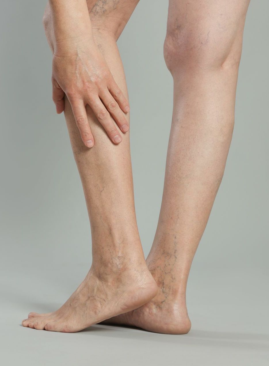 leg pain from varicose veins - treatment in prattville al