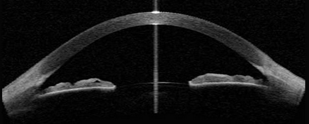 pressione oculare curva tonometrica