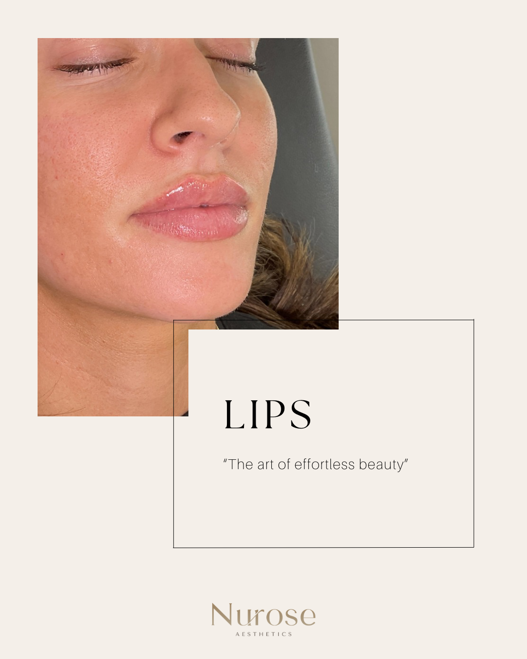 A Before and After Photo of a Woman's Lips — Nurose Aesthetics in Nundah, QLD