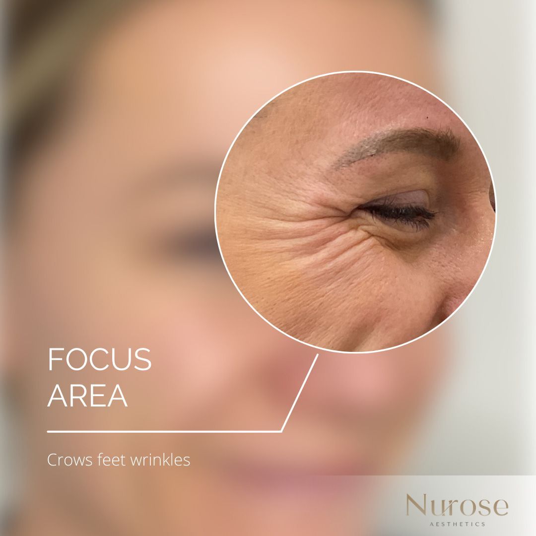 A close up of a woman 's eye with wrinkles.— Nurose Aesthetics in Nundah, QLD