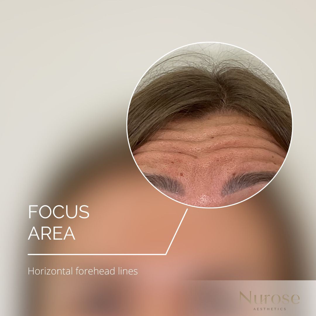 A close up of a woman 's forehead with horizontal forehead lines. — Nurose Aesthetics in Nundah, QLD
