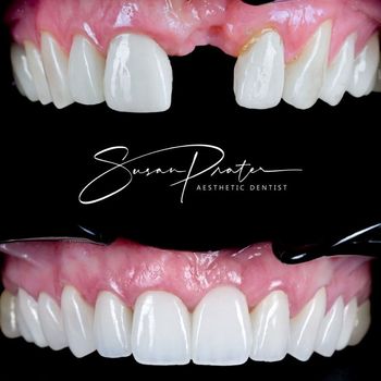 Before-and-after close-up of upper teeth with pink gums, showing improved alignment and brighter white veneers