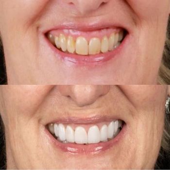 Close-up of a smile before and after teeth whitening, showing brighter white teeth on the bottom.