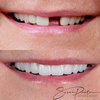 Close-up of teeth before and after whitening, showing a gap and a brighter smile