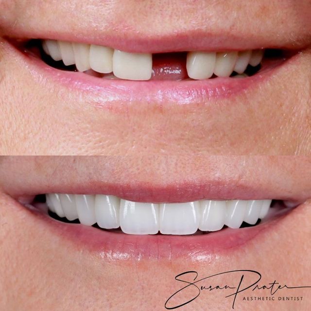 Close-up of teeth before and after whitening, showing a gap and a brighter smile