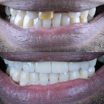Close-up of two smiling mouths, showing teeth before and after whitening treatment