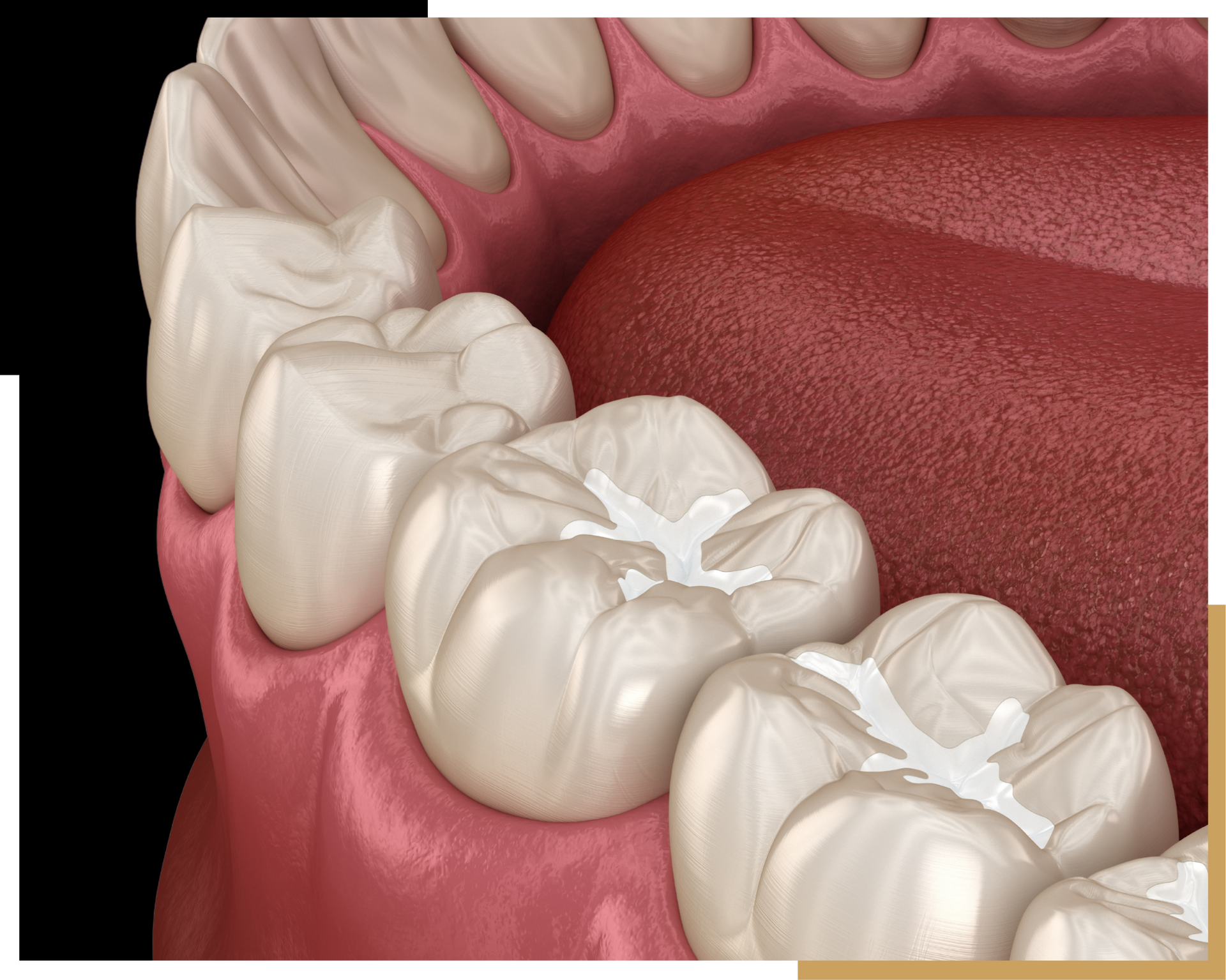 Composite Fillings