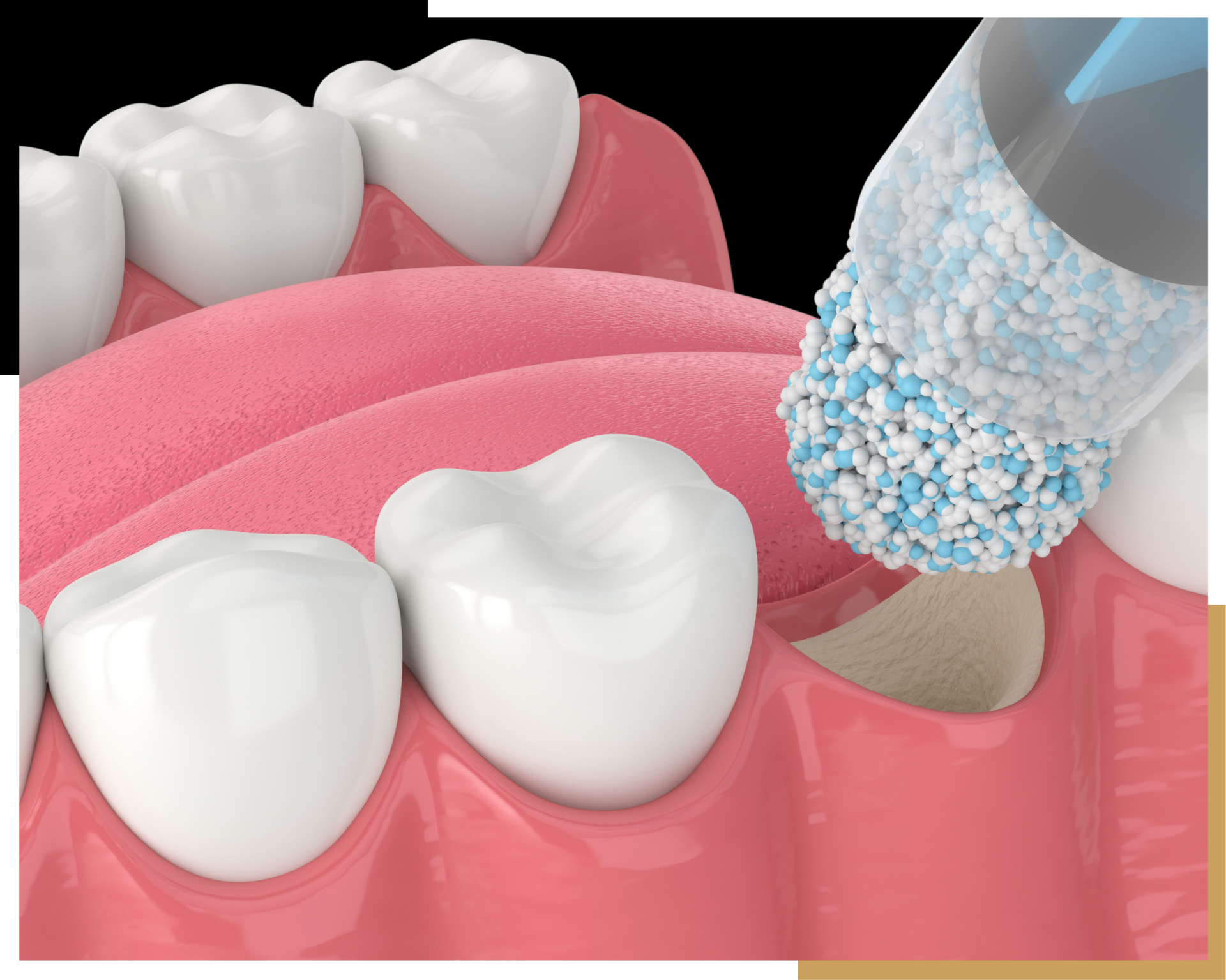 Bone Grafting