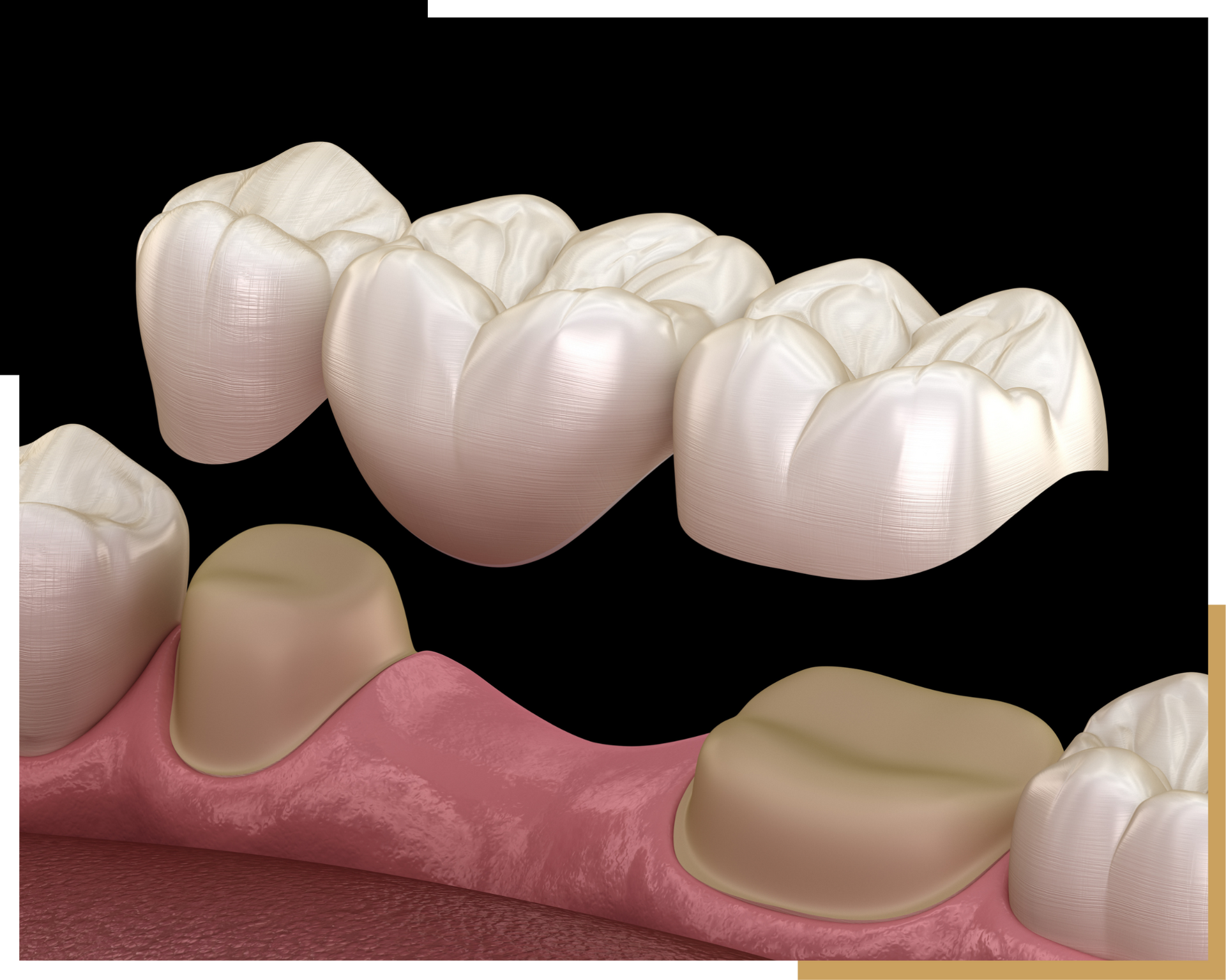 Dental Bridges