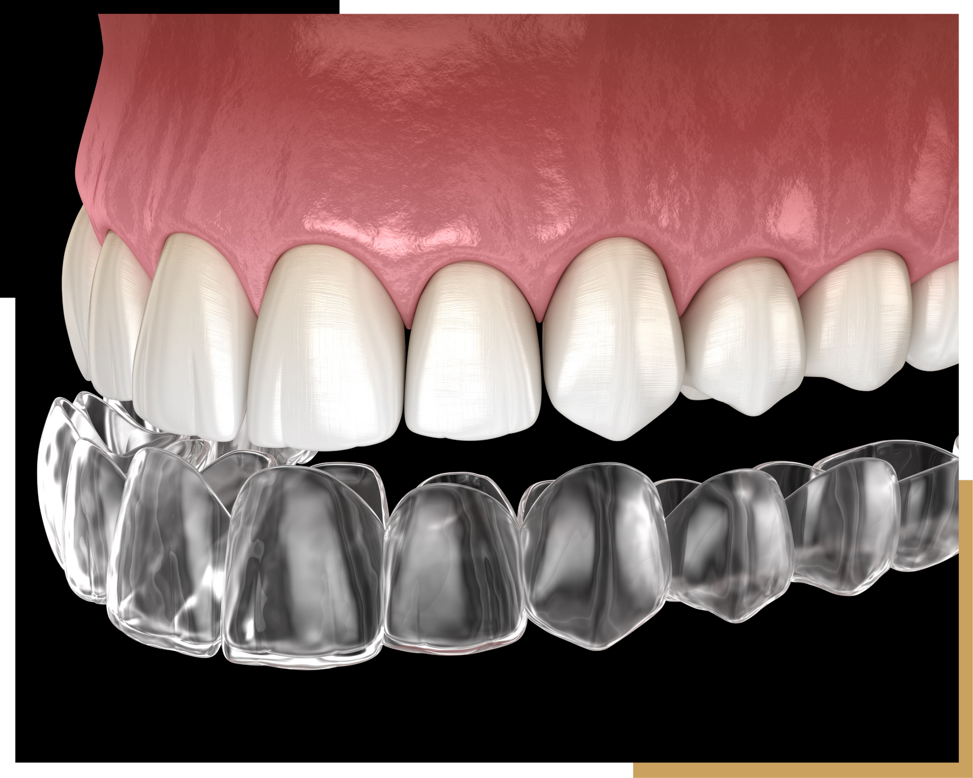Clear Alignment in Jacksonville FL | Orthodontic Services