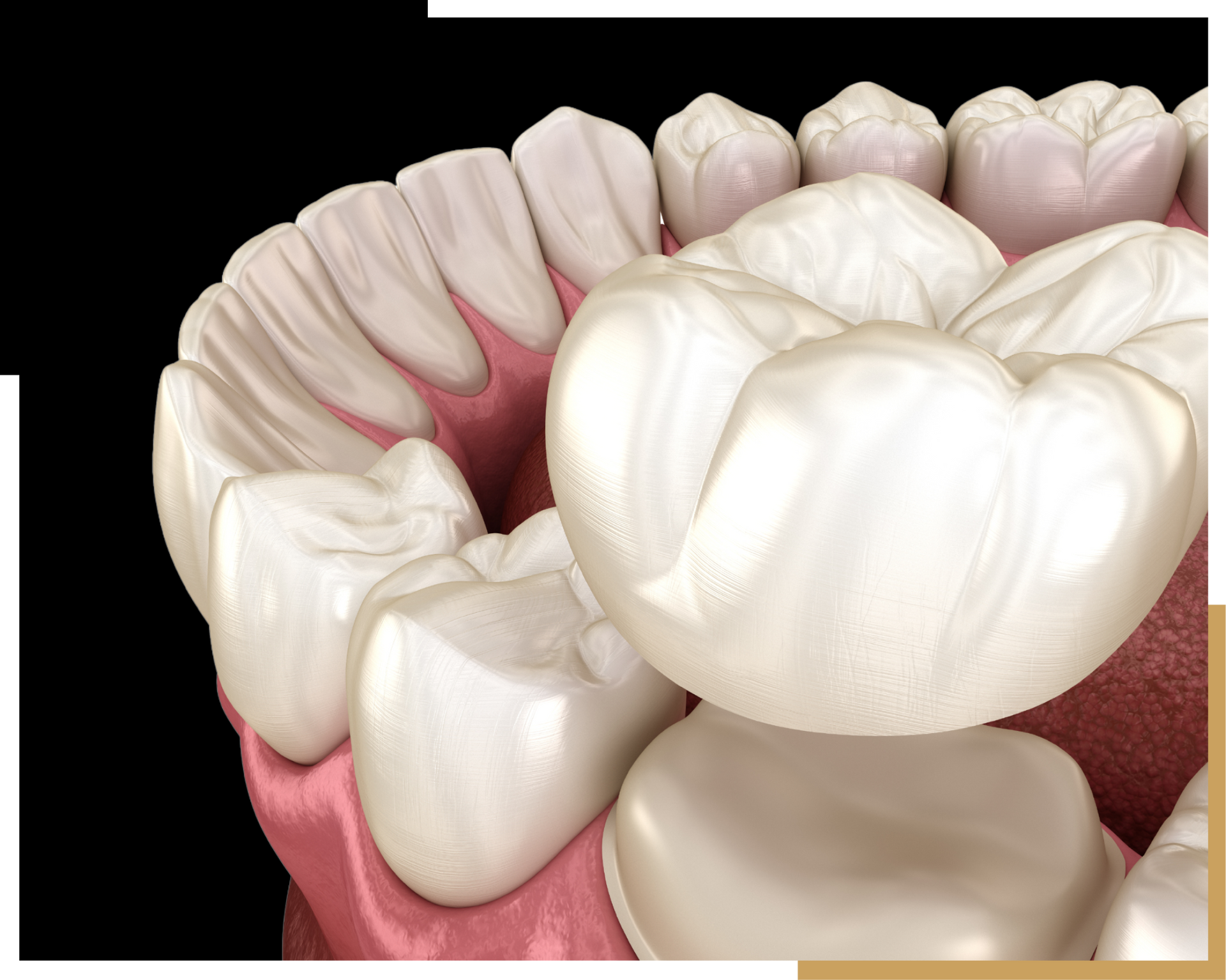 Dental Crowns