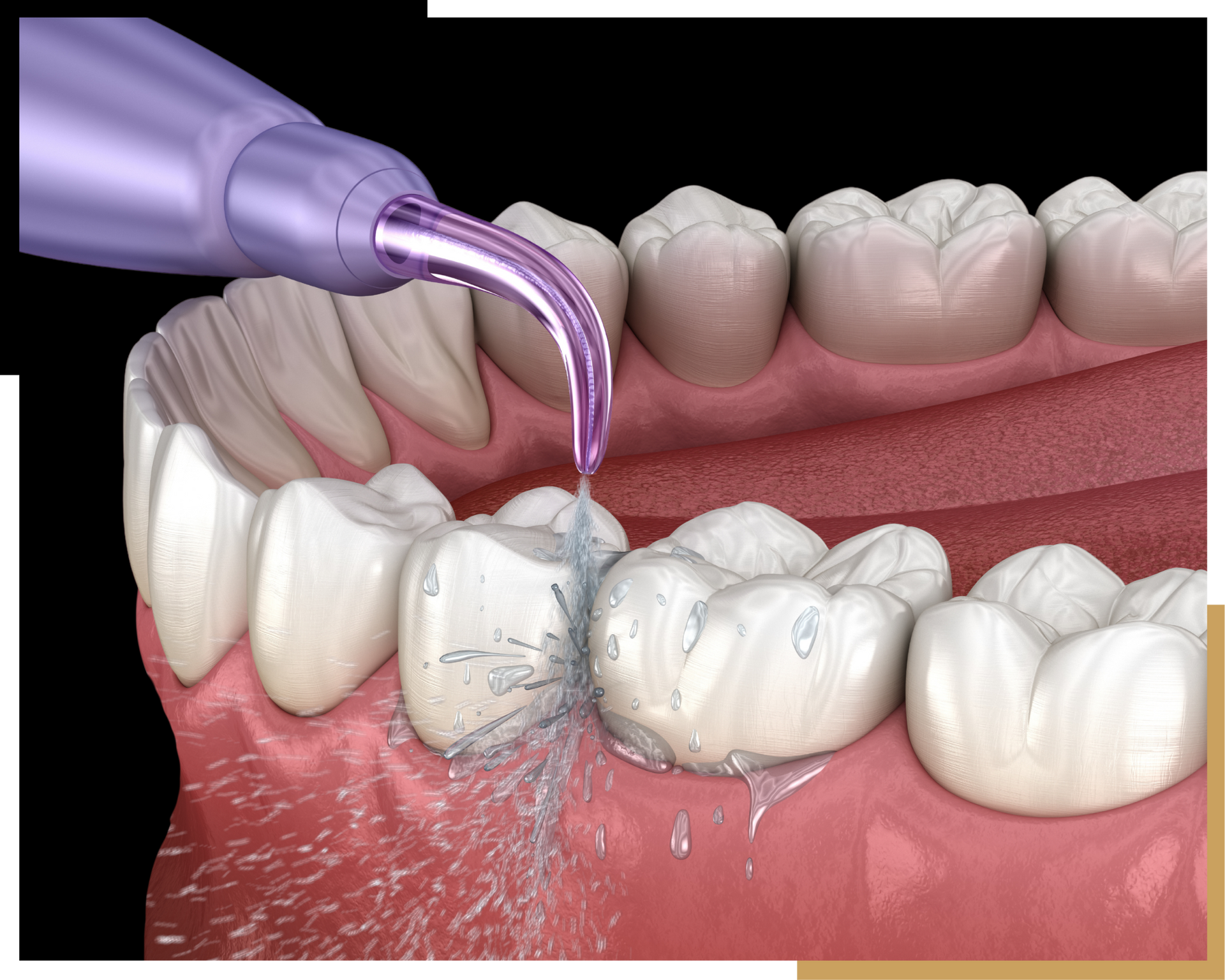 Dental Cleanings