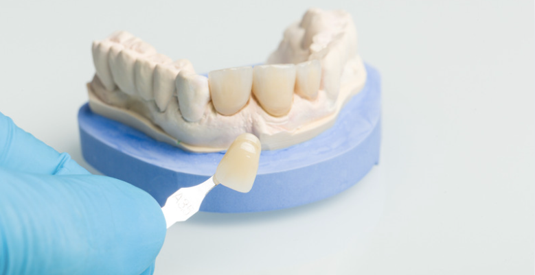 What Happens to Teeth Under Veneers?