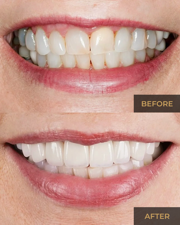 Before-and-after close-up of teeth whitening, showing brighter white teeth and a smile.