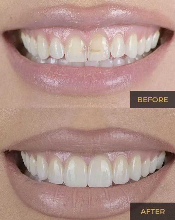 Before-and-after close-up of teeth whitening, showing stained teeth above and brighter white teeth below.