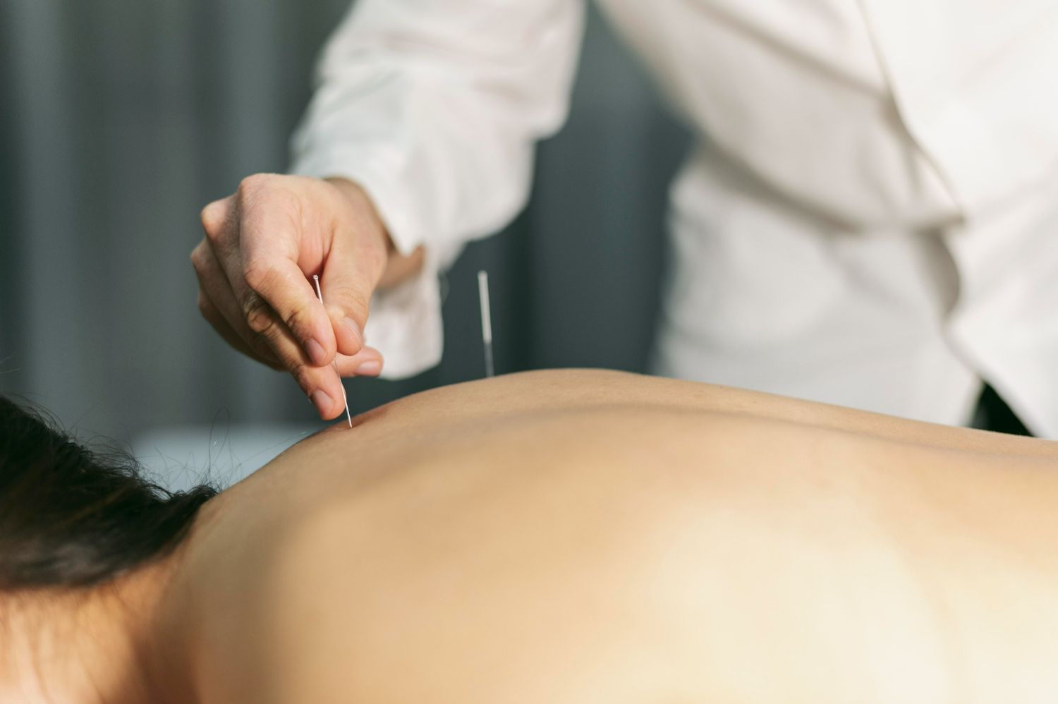 A woman is getting acupuncture on her back by a doctor.