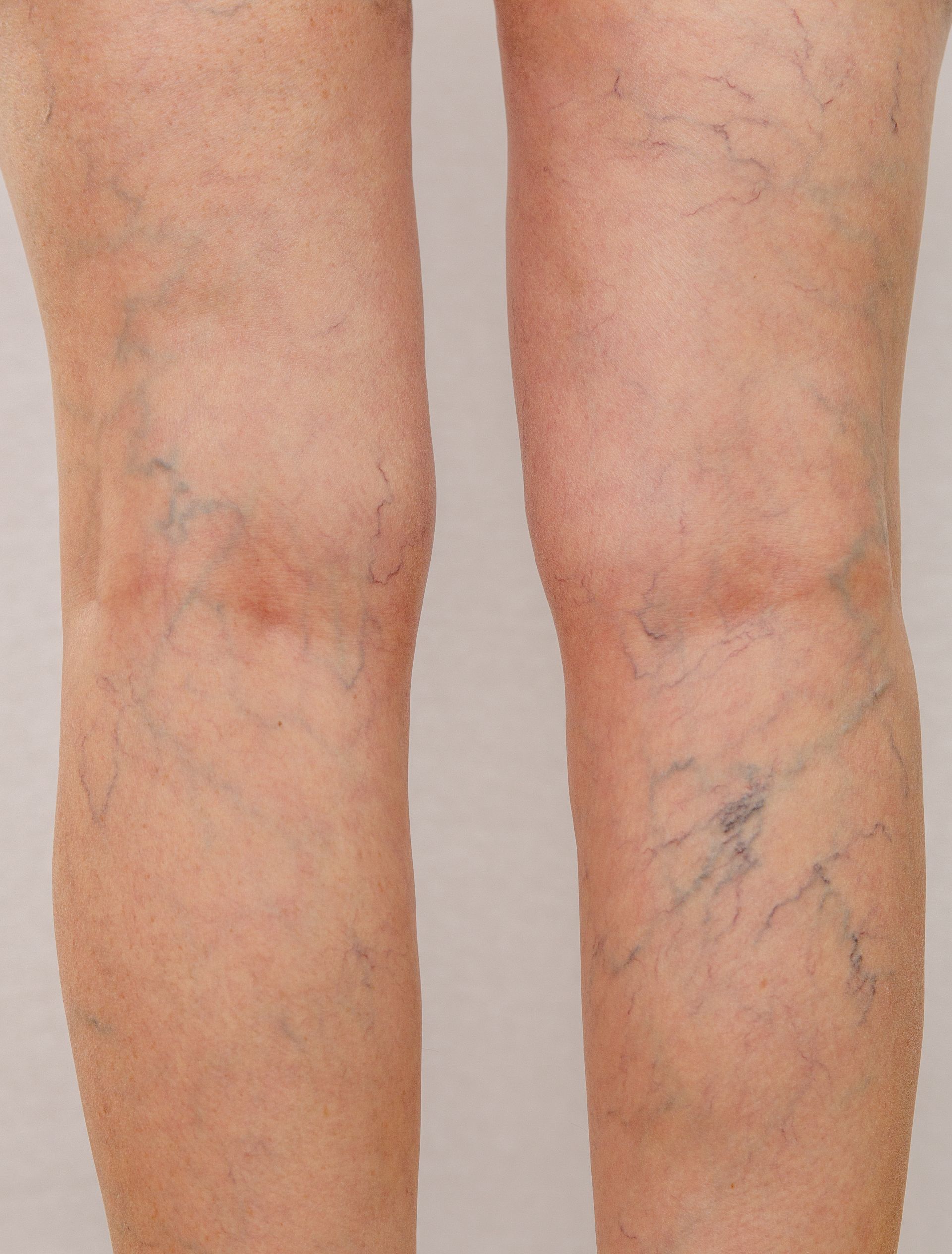 woman with varicose veins