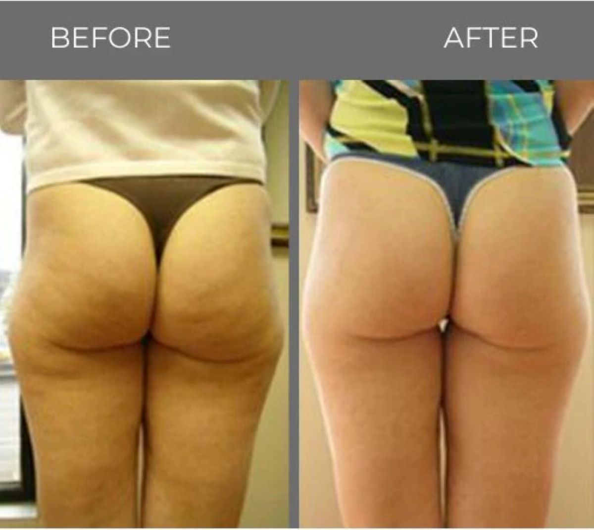 Buttocks comparison: Left, dimpled skin; Right, smoother, firmer appearance.