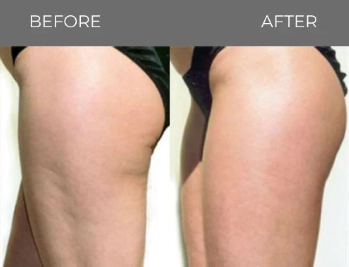 Comparison of a person's thigh, showing cellulite 