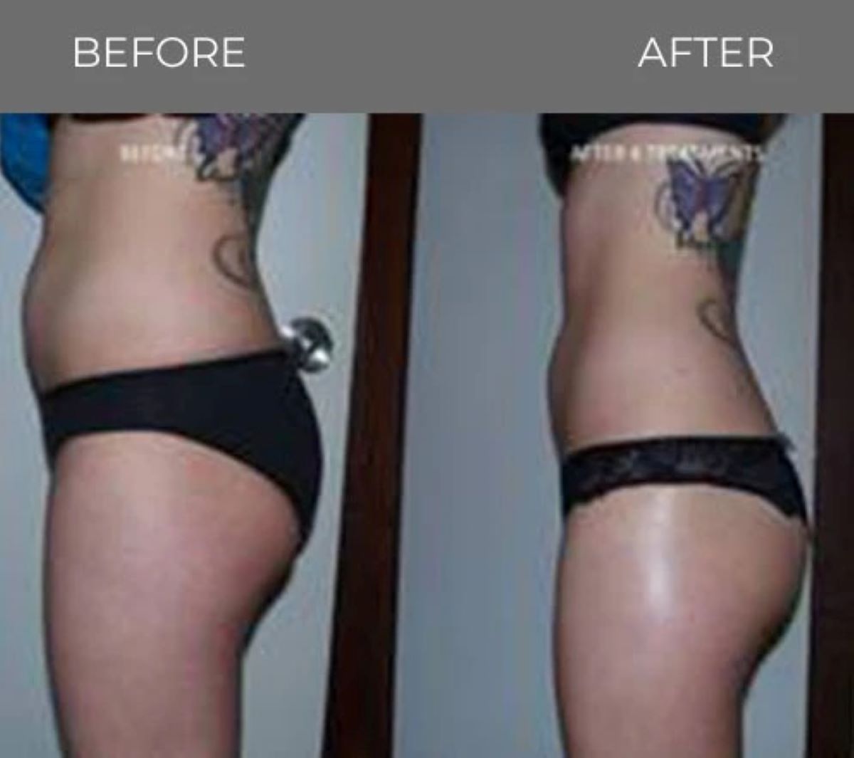 Side-by-side comparison of a person's torso, showing a reduction in waist size and buttock lift.