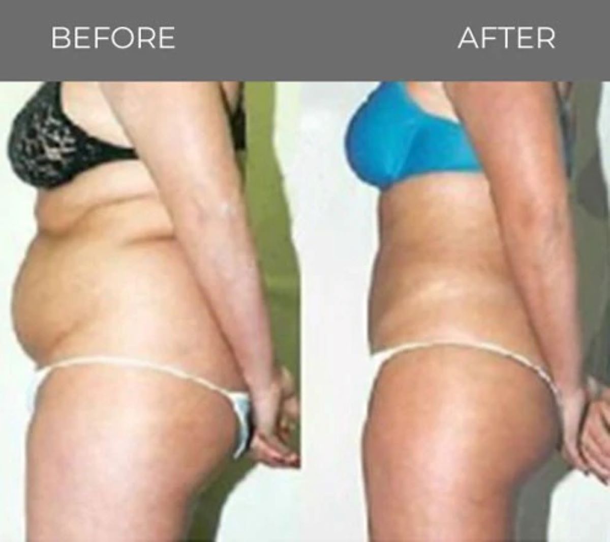 Side-by-side photos comparing a woman's body 