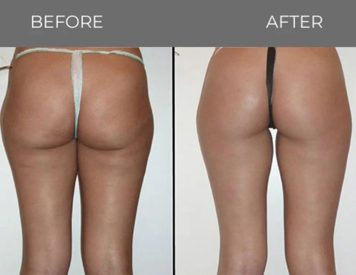 Before and after comparison of buttocks and legs; right side smoother and contoured.