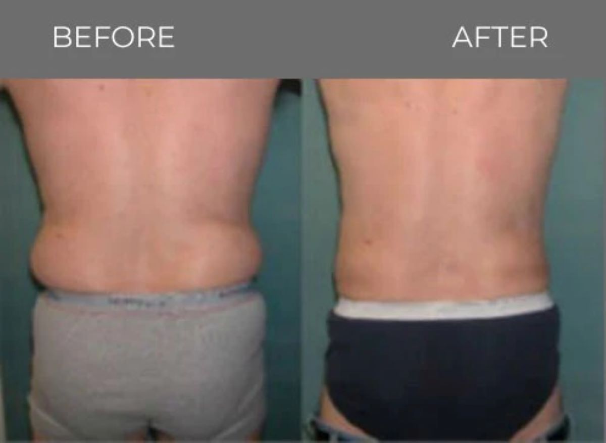 Back view of torso. Before and after fat reduction; noticeable change in contour.
