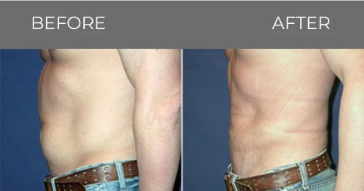 Side-by-side comparison of a torso before and after a procedure, showing reduced abdominal circumference.