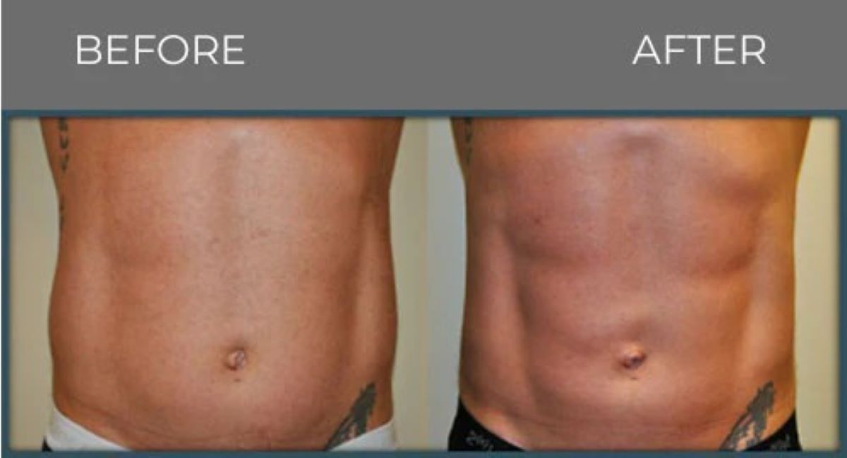 Comparison of a person's abdomen before and after a procedure. The 