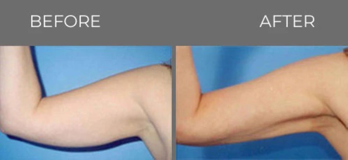 Arm lift: Before and after comparison. The 