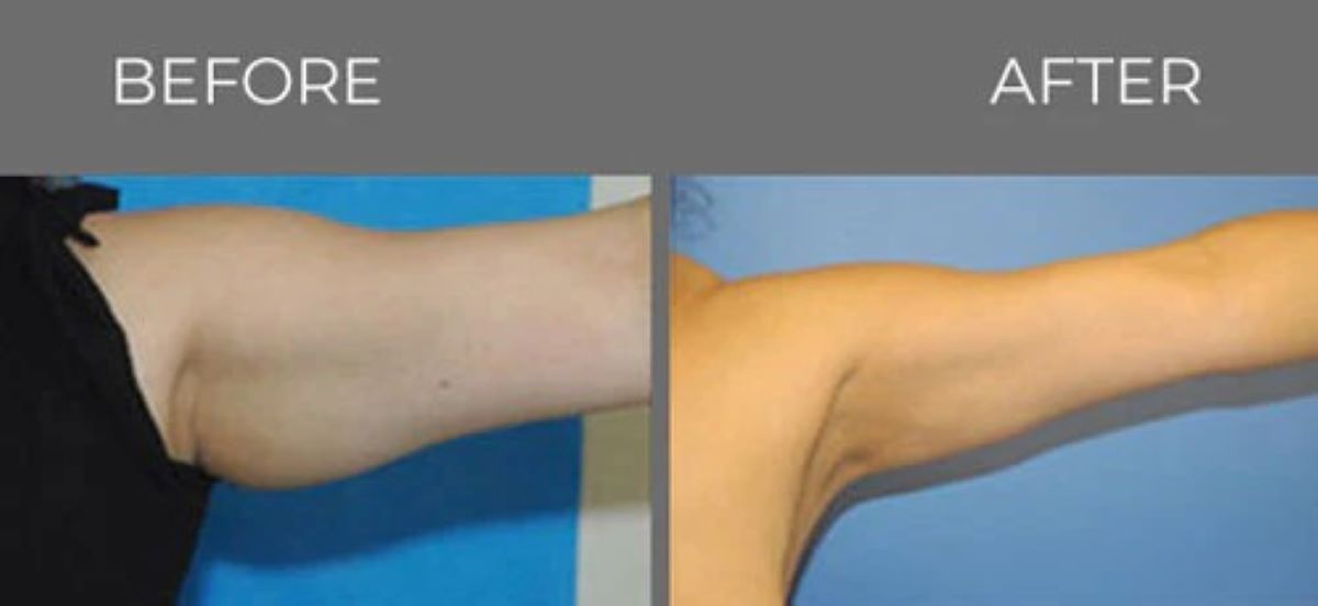 Before and after view of arm, with loose skin removed and a more defined shape.