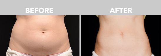 CoolSculpting for A Toned Tummy Before & After Photos New Jersey