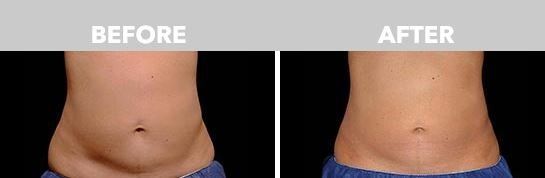 Coolsculpting Near Holmdel, NJ & Colts Neck, NJ