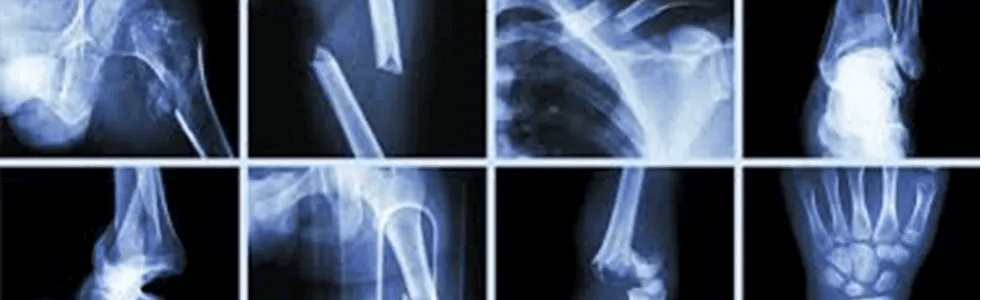 radiografie di ossa lesionate e rotte