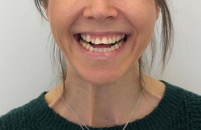 Pasient sine tenner før usynlig tannregulering