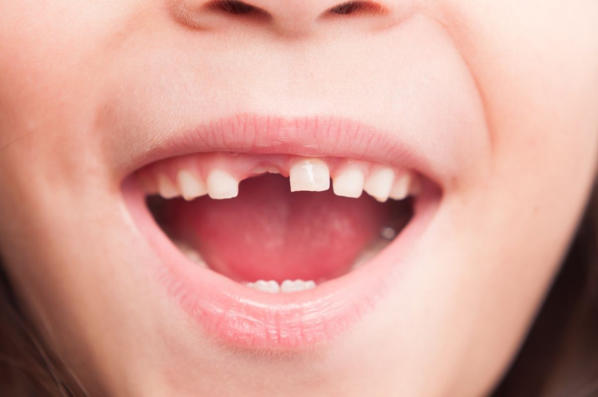 A close up of a child 's mouth with a missing tooth.