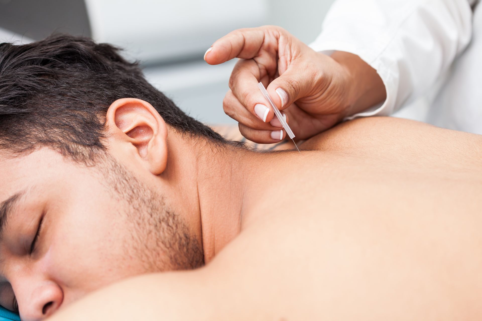 a man getting an Acupuncture treatment on his back