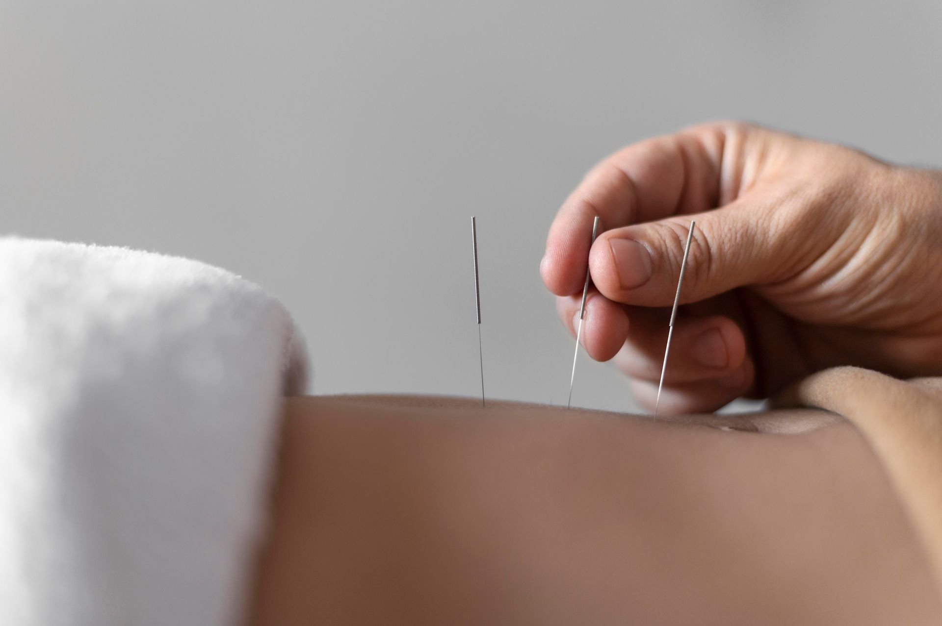 a person is getting acupuncture on their back