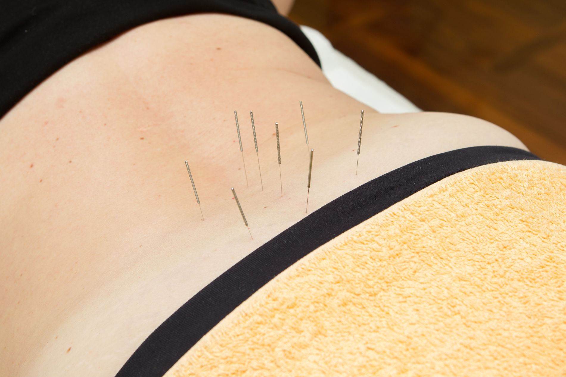 Trattamenti di agopuntura