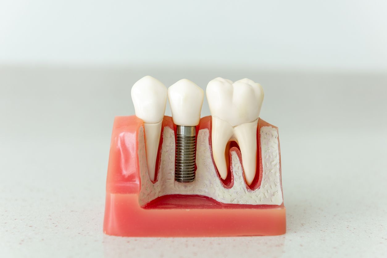 Dental implant model showing teeth, gums, and a metal implant post in a cross-section model