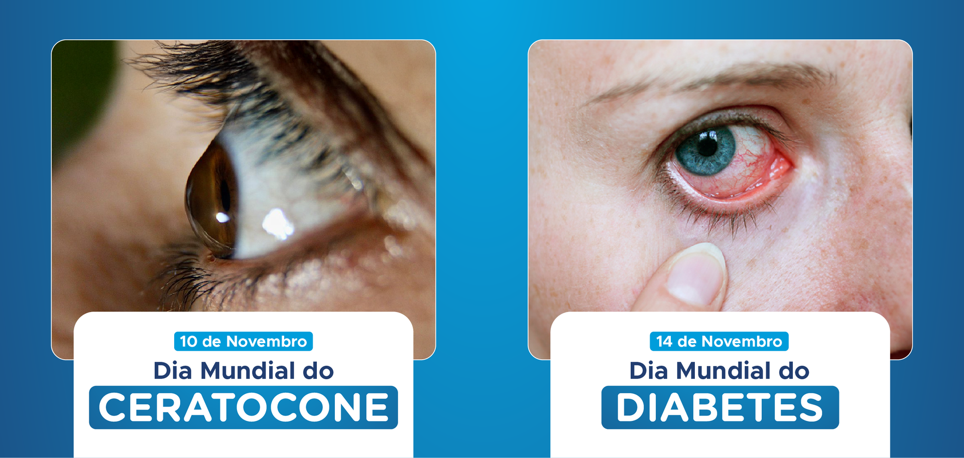 Novembro: Dia Mundial do Ceratocone e Dia Mundial do Diabetes – Cuidando da Saúde Ocular
